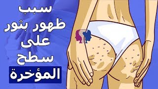 أسباب ظهور الحبوب على سطح المؤخرة.. هل تدل على مرض خطير؟ متى تحتاج إلى زيارة الطبيب؟