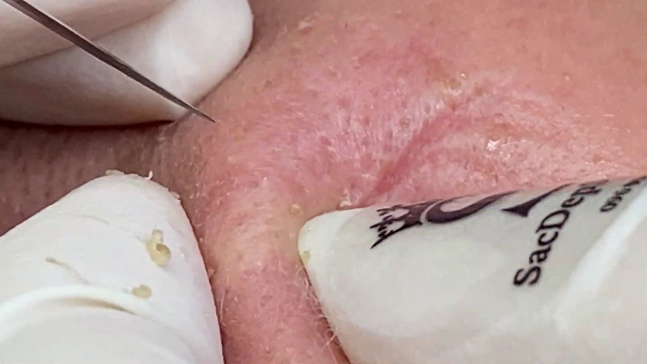 remove acne, clean pores for girls rainy day part 2 #thuytruong#37
