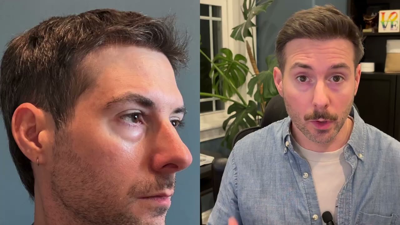 10 Month update - 4,000 Grafts - Hair Transplant at the Cosmedica Clinic in Istanbul with Dr. Acar