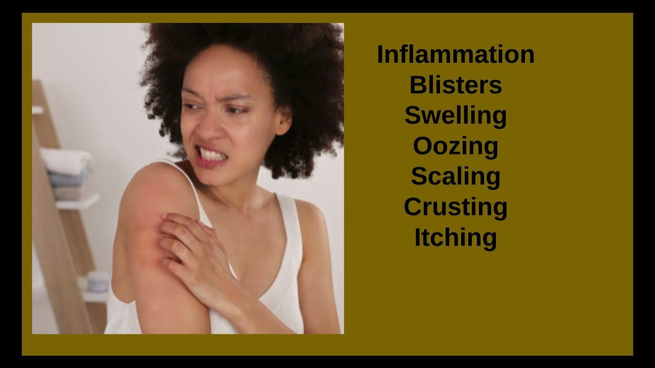 Eczema and African Americans - YouTube
