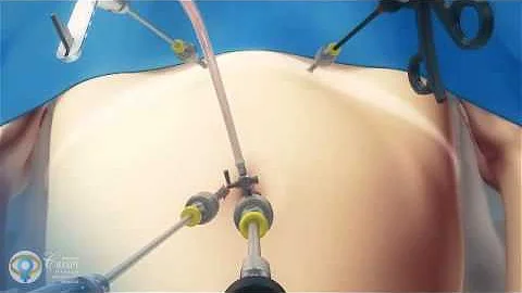 Qual anestesia é usada para videolaparoscopia?