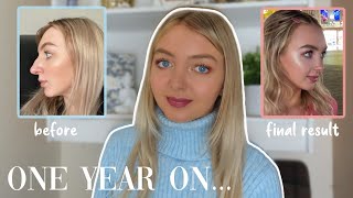 My ONE YEAR Nose Job Update! rhinoplasty final result & side effects