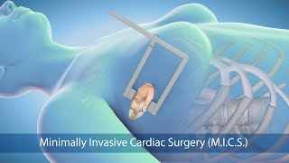 Medical Animation Minimally Invasive Cardiac Surgery Mics At Sarasota Memorial Hospital