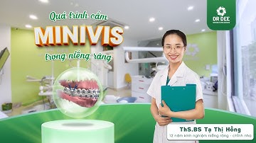 Quy trình “cận cảnh” cắm minivis – bí kíp thần thánh rút ngắn 6 tháng niềng răng chỉnh nha