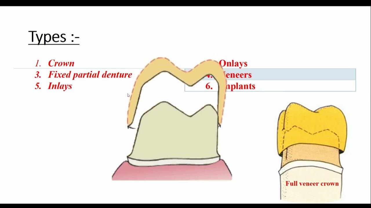 preclinical fixed prosthodontics (terminology) YouTube