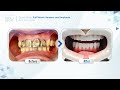 Bleu dentistry case study full mouth veneers and implants