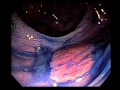 Use of Indigo Carmine Solution in Endoscopic Identification and Resection of Nonpolypoid Colorectal