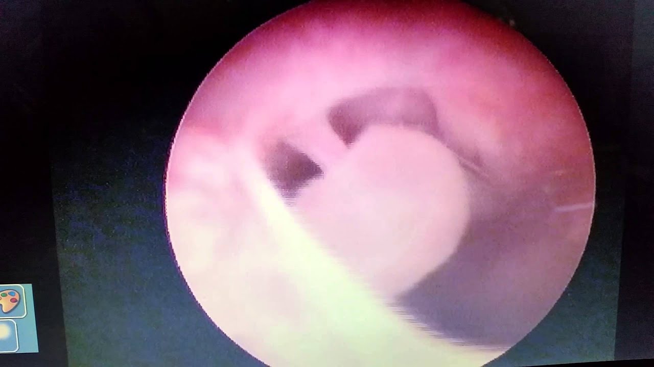 Endoscopic View Of Sex 88