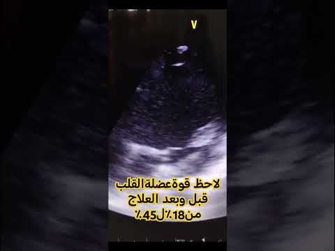 تقوية قلب من 18 ل 45 وما توفيقي الا بالله عاد المريض لقرب حياته ونشاطه الطبيعي