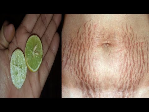 3 दिन में स्ट्रेच मार्क्स को जड़ से खत्म कर देगा ये नुस्खा / Stretch Marks Remove in 3 Days