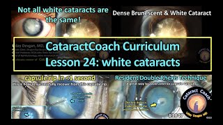 CataractCoach™1847: Curriculum lesson 24 white cataracts