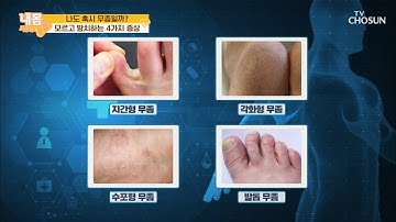 나도 혹시 무좀?! 증상에 따른 〈4가지 무좀 종류〉 [내 몸 사용설명서] 316회20200821