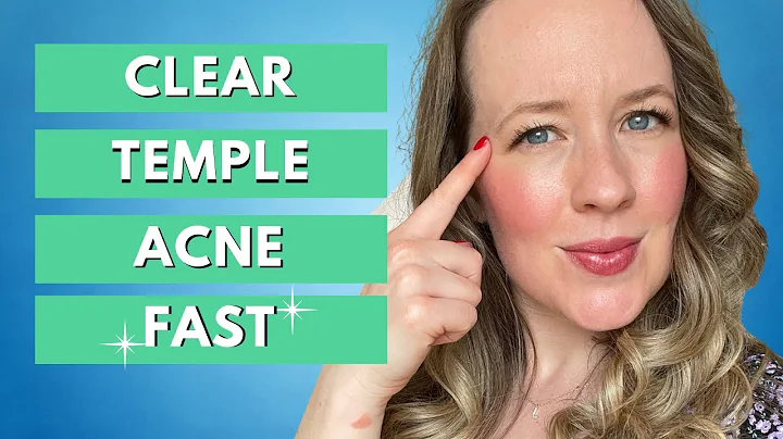 Acne on temples - CLEAR TEMPLE ACNE FAST!