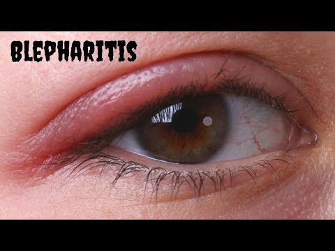 Video: Penggunaan Scrub Kelopak Mata, Rawatan Blepharitis, Dan Cara Membuatnya Sendiri