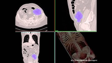 Semi-Automatic Kidney Segmentation in CT