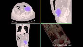 Semi-Automatic Kidney Segmentation in CT