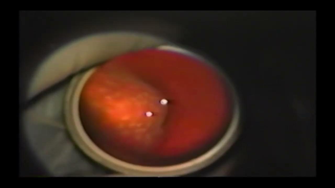 Retinal detachment Encircling laser retinopexy technique