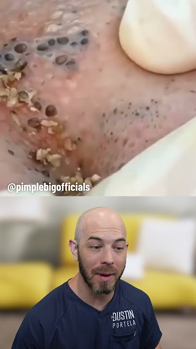 Dozens and dozens of blackheads on the face 😰 (credit: @pimplebigofficials on TT) #fyp #reaction