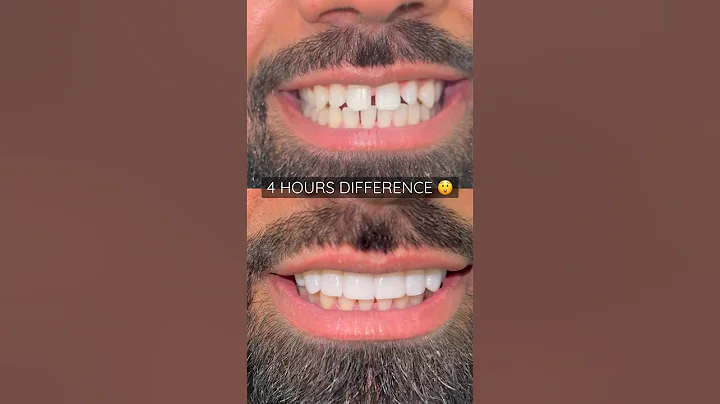 Composite bonding by Dr. Sulley #cosmeticdentistry #ruhdental