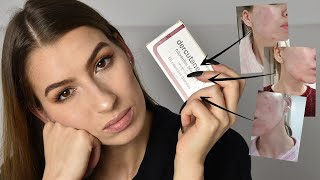 Como acabé con mi ACNÉ con isotretinoína - DERCUTANE