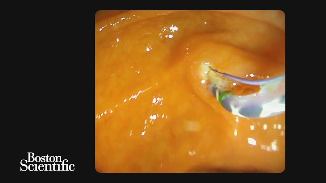 Model D and SpyGlass System Dr. Varadarajulu