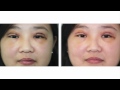 Double Eyelid Surgery along with Epicanthoplasty | Dr. Thomas Buonassisi, 8 West Clinic in Vancouver