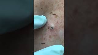 GIANT Blackhead removed from the Back w/ Dr. Pimple Popper shorts