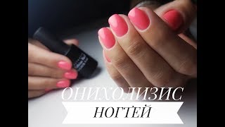 ОНИХОЛИЗИС НОГТЕЙ, ПОКРЫТИЕ ГЕЛЬ ЛАКОМ ОНИХОЛИЗИС НОГТЕЙ, ПОКРЫТИЕ ГЕЛЬ ЛАКОМ