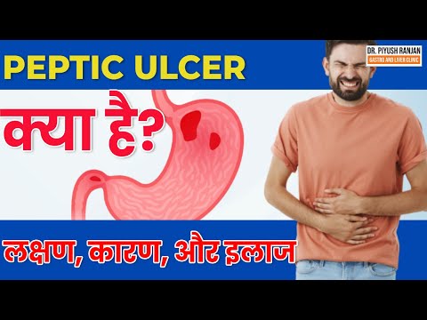 वीडियो: ग्रहणी संबंधी अल्सर किसे हो सकता है?