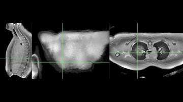 Pulmonary Lung Imaging Using 3D Dual-Echo Ultra-short Echo Time Modified Rosette k-space: PETALUTE