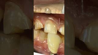 Great Amber Press Tooth @HASSBIO @EnvisiontecMain #envisiontec #hassbio #hassambassador