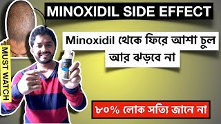 Side effect of Minoxidil. মিনোক্সিডিল লাগানো ছেড়ে দিলে চুল আবার কেন ঝড়ে?