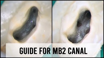 Guide for locating and preparing hidden MB2 canal
