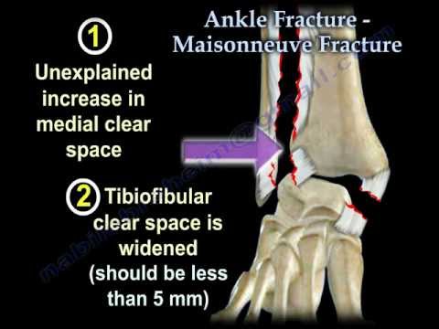 Ankle Fracture Maisonneuve Fracture - Everything You Need To Know - Dr. Nabil Ebraheim