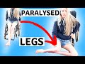 ♿️MY PARALYSED LEGS | #limbdifferenceawarenessmonth