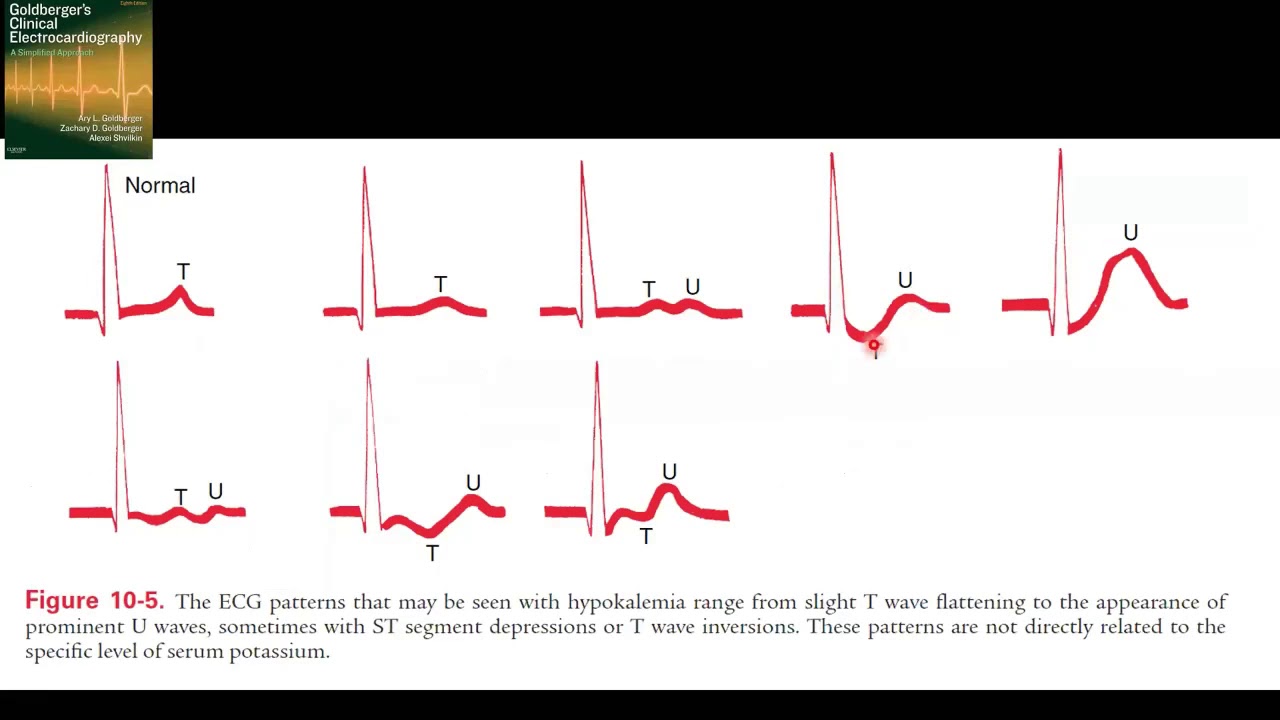 EKG Pada Pasien dengan Gangguan Elektrolit