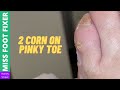2 lovely Corns removal from toe | Miss Foot Fixer