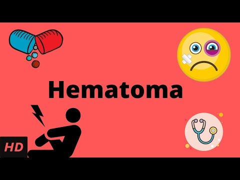 Hematoma, Causes, Signs and Symptoms, Diagnosis and Treatment.