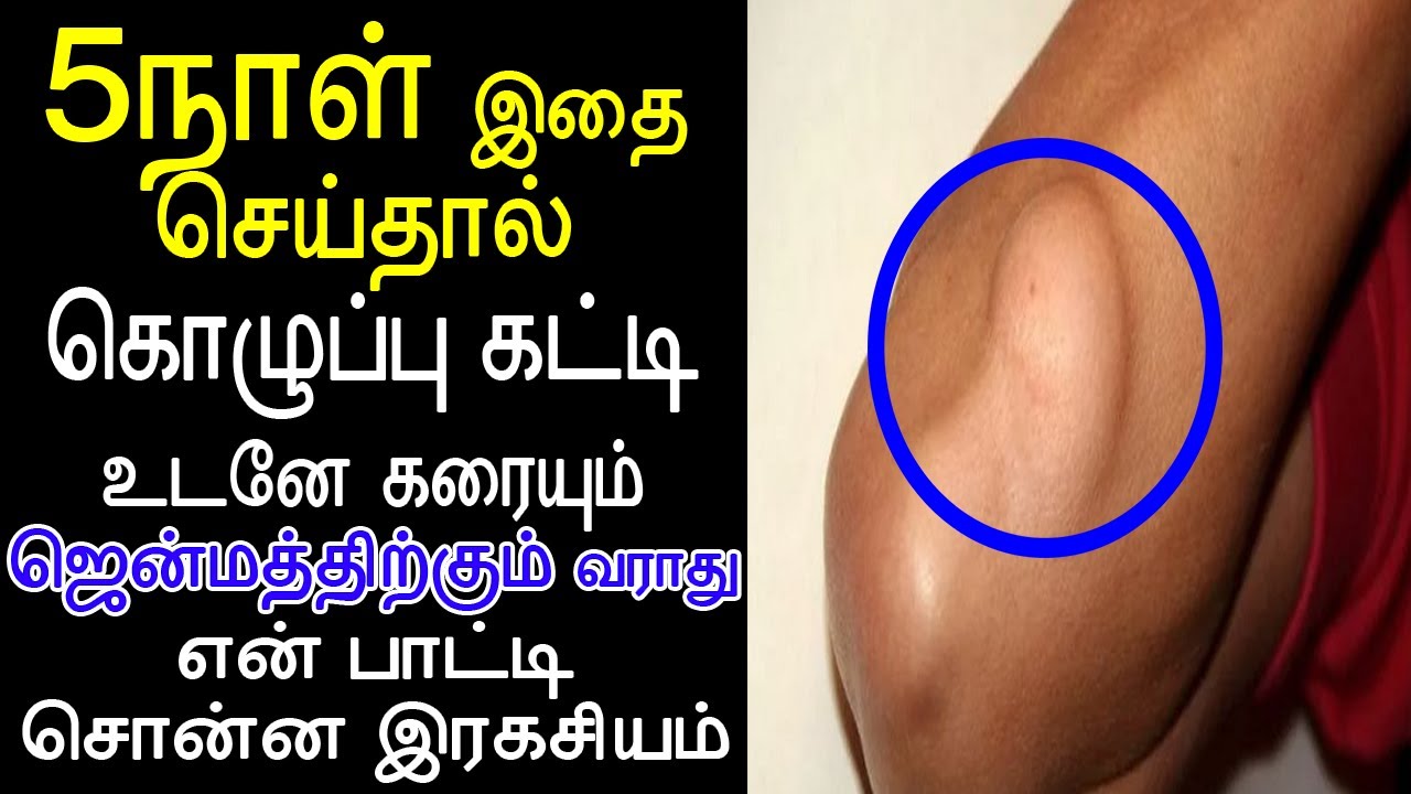5நாள் செய்தால் கொழுப்பு கட்டி எளிதில் கரையும் | LIPOMA Treatment in Tamil Kozhuppu  Katti in tamil - YouTube