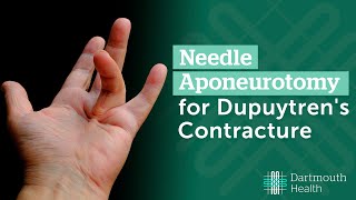 Needle Aponeurotomy for Dupuytren's Contracture