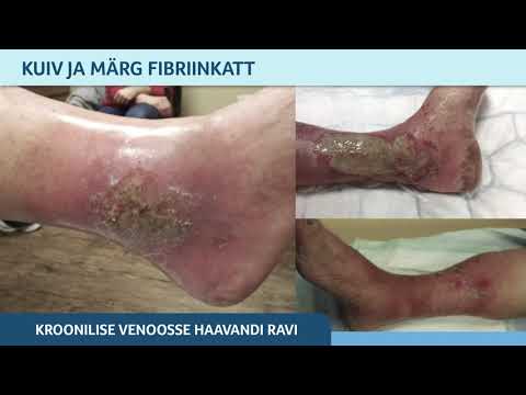 Video: Venoosse ärrituse Riskifaktorid Vinorelbiini Saavatel Patsientidel: Tagasiulatuv Uuring