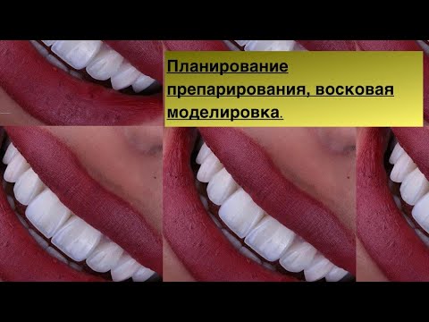 Video: Výplň Zubov - Moderné Metódy Výplne Zubov