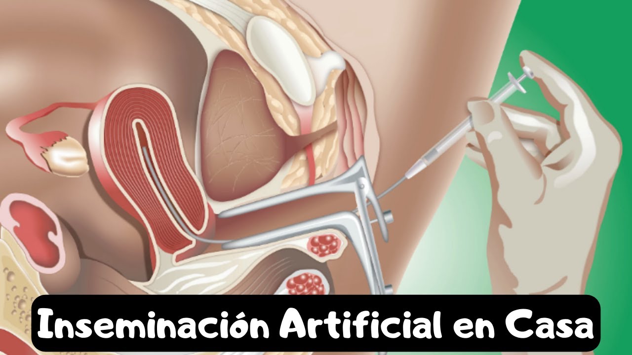 Inseminación Casera, Dudas. Parte 1 