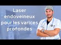 Laser endoveineux pour les varices profondes