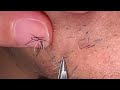 Plucking beard super clean and clear #beardcare #asmrskincare #satisfyling #plucking #skincare 