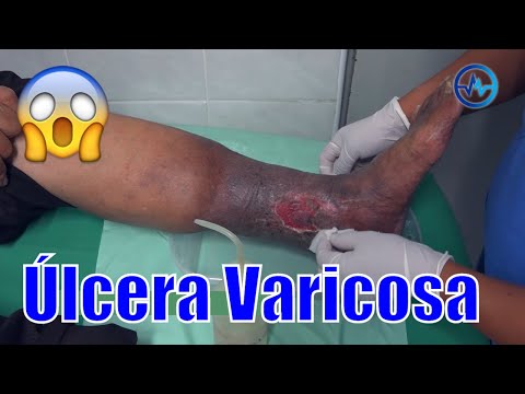 Vídeo: Rodilla De Piel: Tratamiento En El Hogar, Signos De Infección, Recuperación