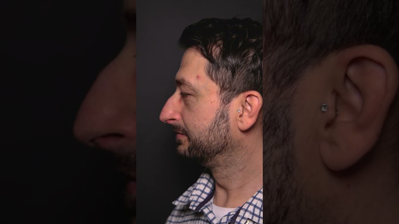 Rhinoplasty Before & After / Nose Job 