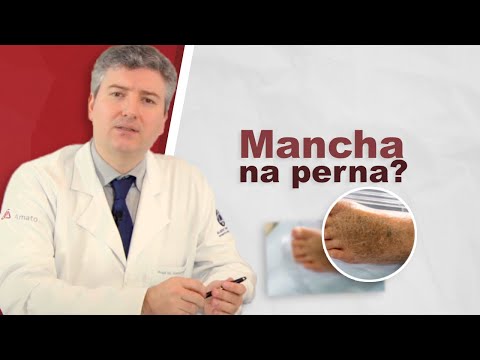 Dermatite ocre. Tem como clarear as manchas nas pernas?