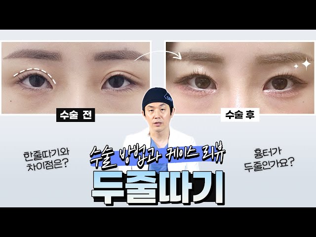 👁‍🗨 소시지 쌍꺼풀, 두줄따기는 어떻게 하는 걸까? (feat. 케이스 리뷰)