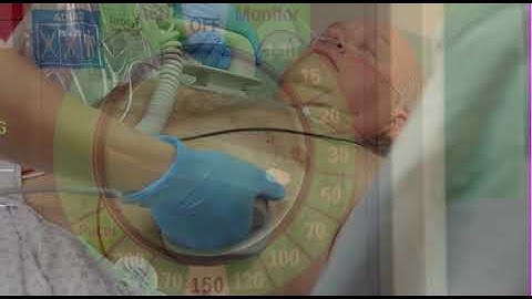 Synchronized Cardioversion with the Efficia DFM100 monitor/defibrillator